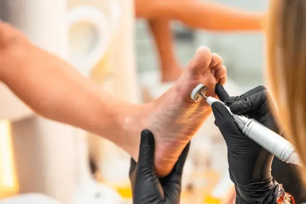 callus removal treatment in austral, nsw