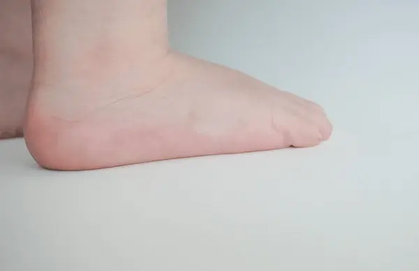flat feet treatment in austral, nsw