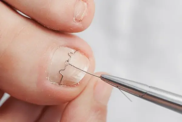 ingrown toenail treatment in austral, nsw