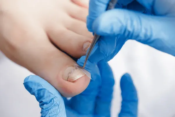 ingrown toenail treatment near you