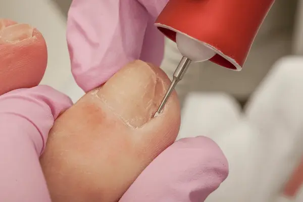 nail deformity treatment in austral, nsw