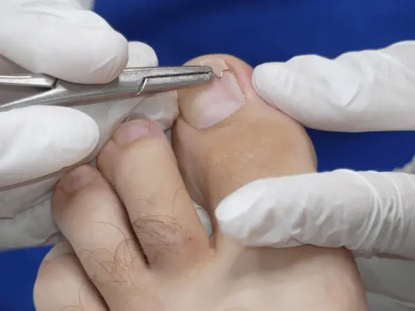 nail deformity treatment near you