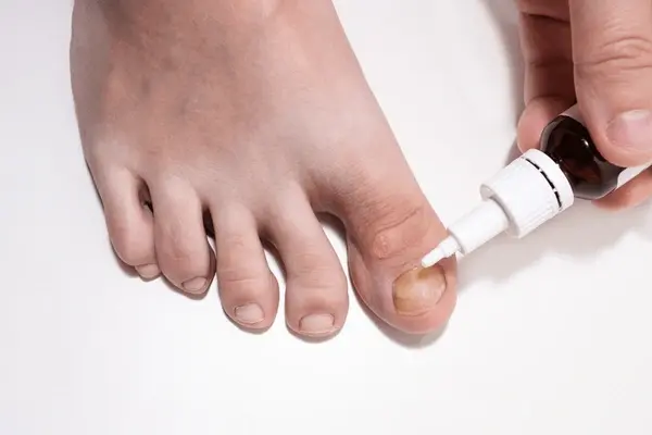 nail discoloration treatment in austral, nsw