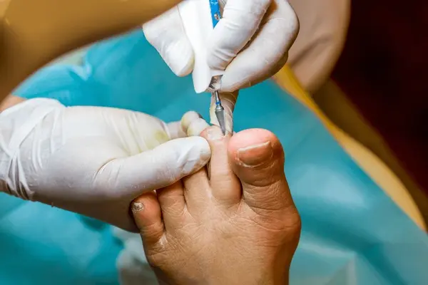 nail edge removal near you