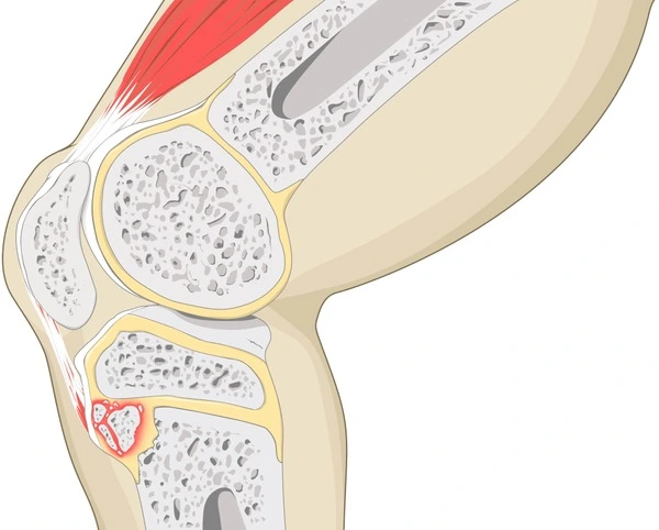 osgood schlatter disease treatment near you