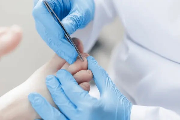 partial nail avulsion near you