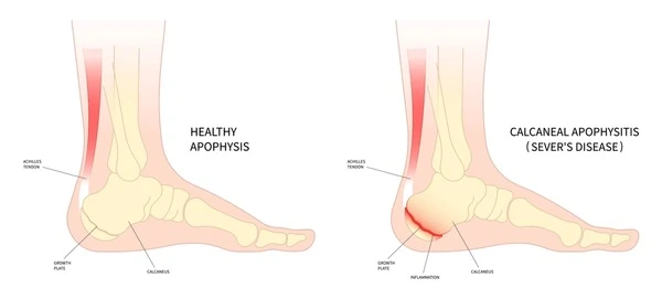 severs disease treatment near you
