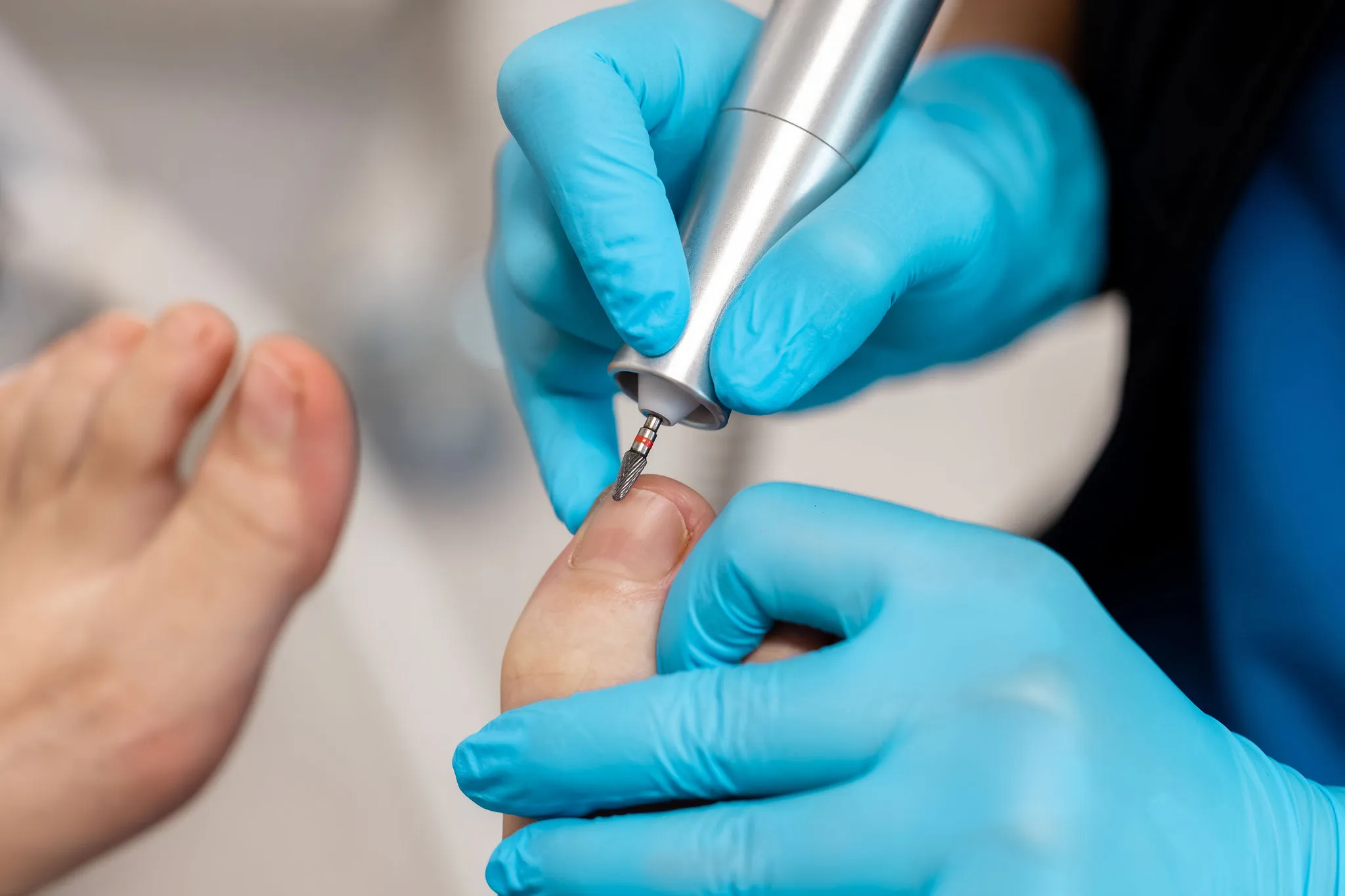 tinea pedis treatment in austral, nsw