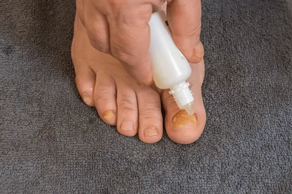 topical fungal treatments in austral, nsw