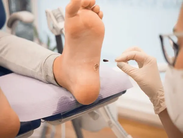 topical wart therapy in austral, nsw